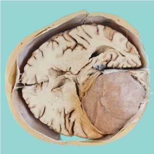 Νεκροτομικό παρασκεύασμα εγκεφάλου με νεόπλασμα / μηνιγγίωμα